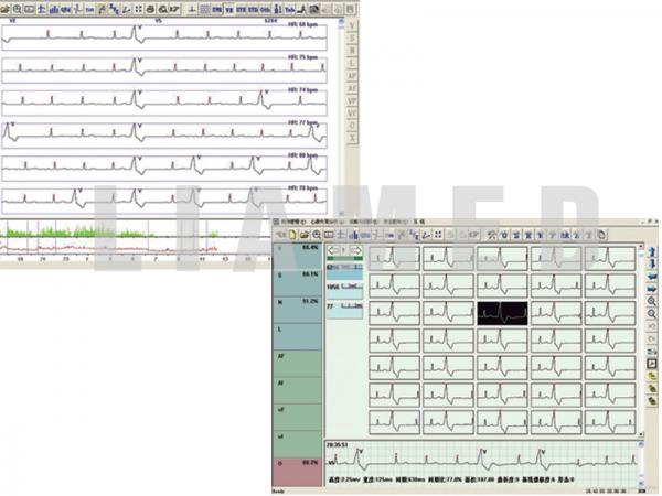 Examinare făcută cu Holter ECG TLC5000 