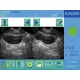 Examinare făcută cu Scanner vezica urinara BVT01 